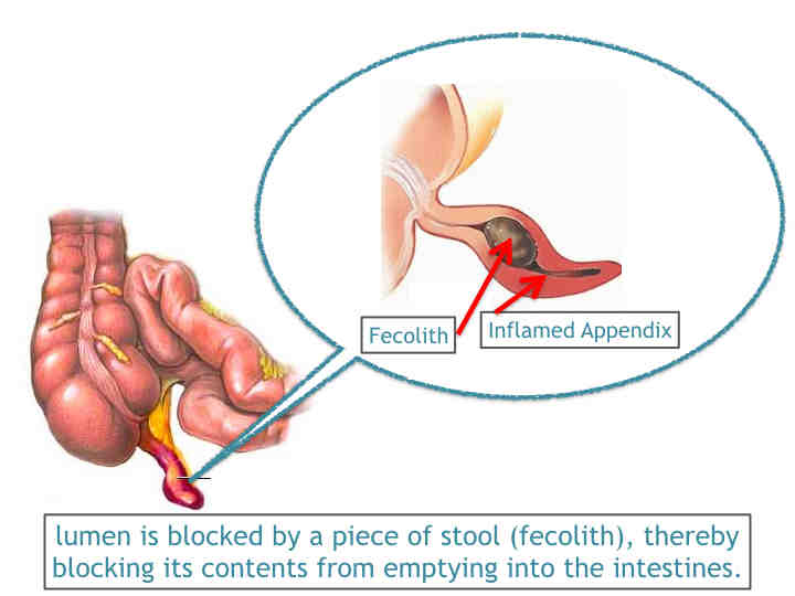 Acute appendicitis