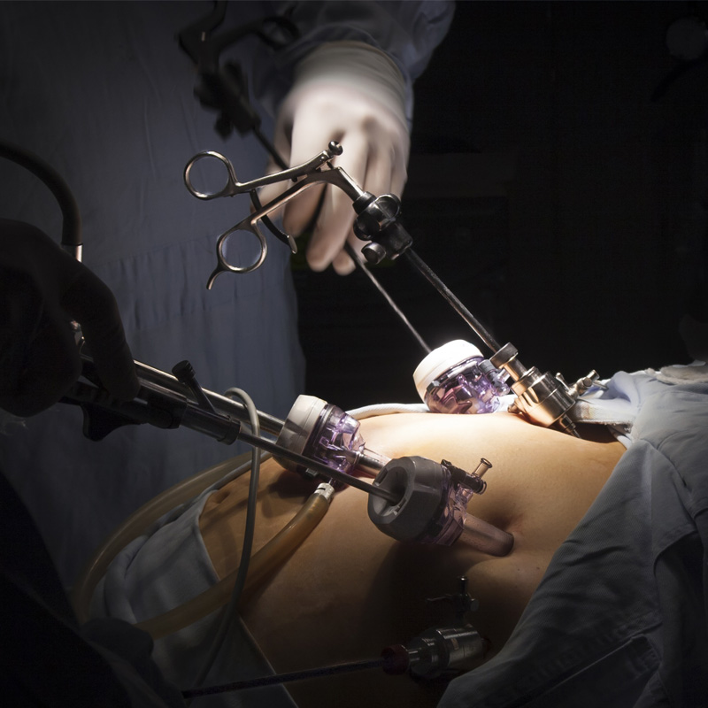 Why you need Metabolic GI Surgery