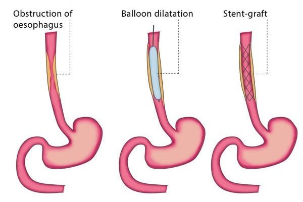 GastrointestinalStenting600x520-600x520