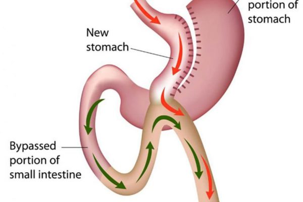 Mini-Gastric-Bypass