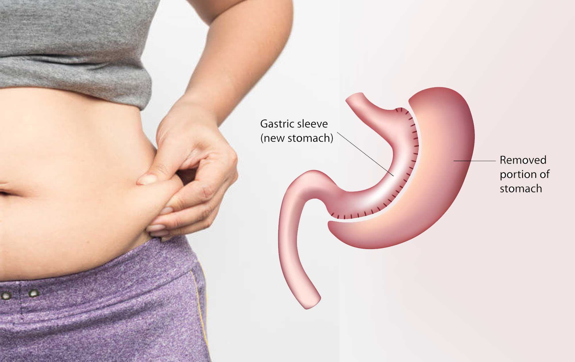 Laparoscopic sleeve gastrectomy journey for a young man
