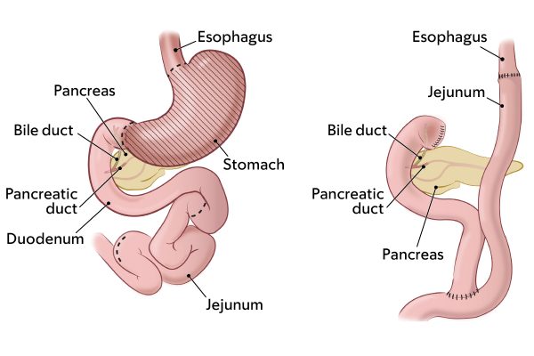 Total gastrectomy