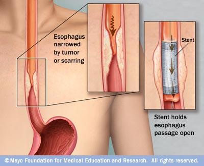 eso stenting