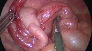 inflamed appendix
