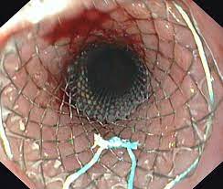 stent