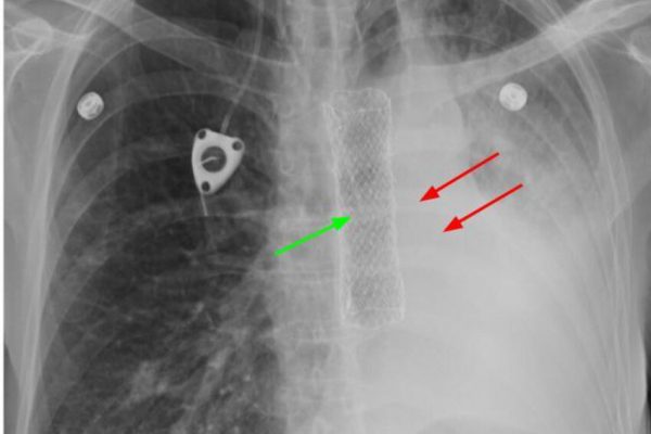stent XR