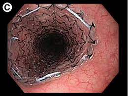 stent