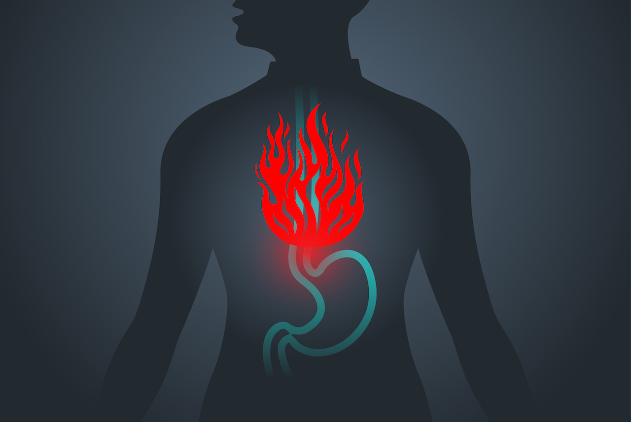 GERD & anti-reflux surgery