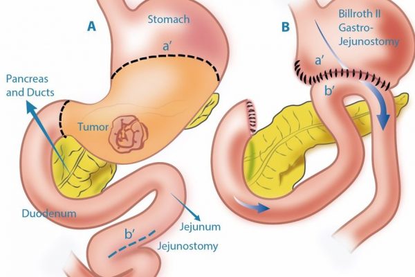 Partial-gastrectomy