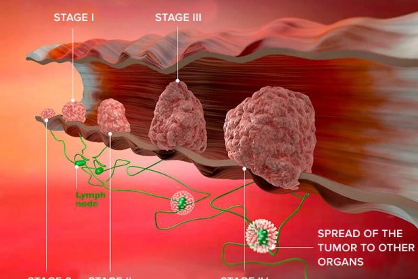 stages-of-cancer