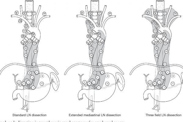 3 field LN esophagectomy